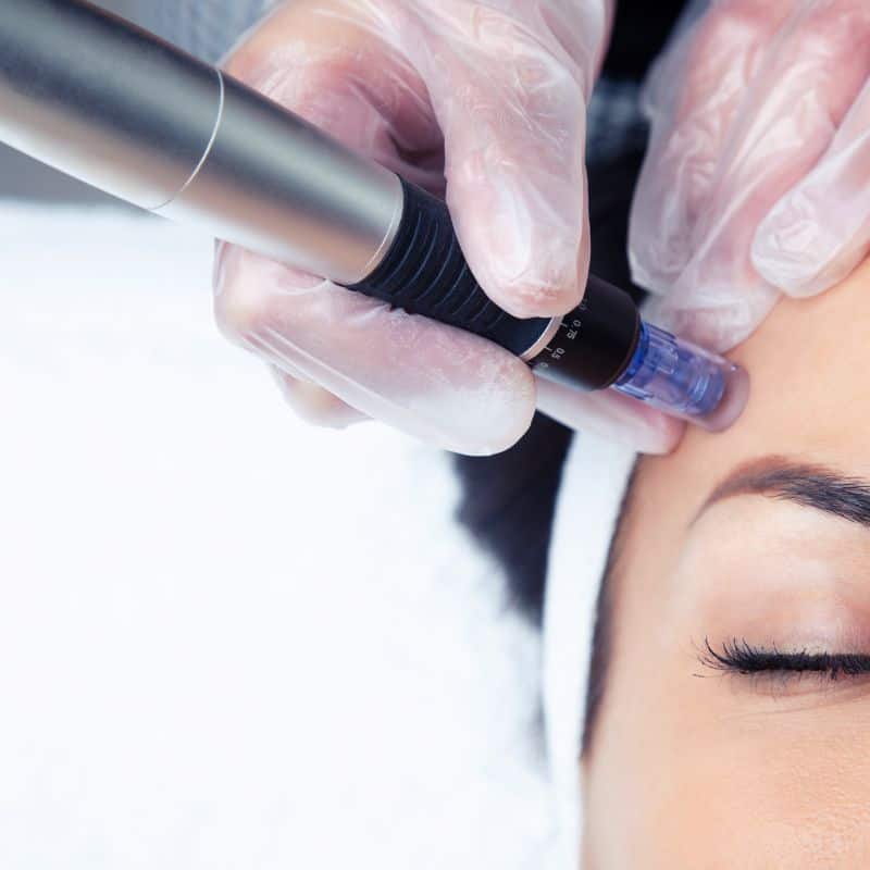 Morpheus8 treatment Bury from Lipo Sculpt - Book in today!
