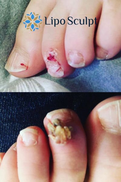 Wart removal customer results from Lipo Sculpt Bury